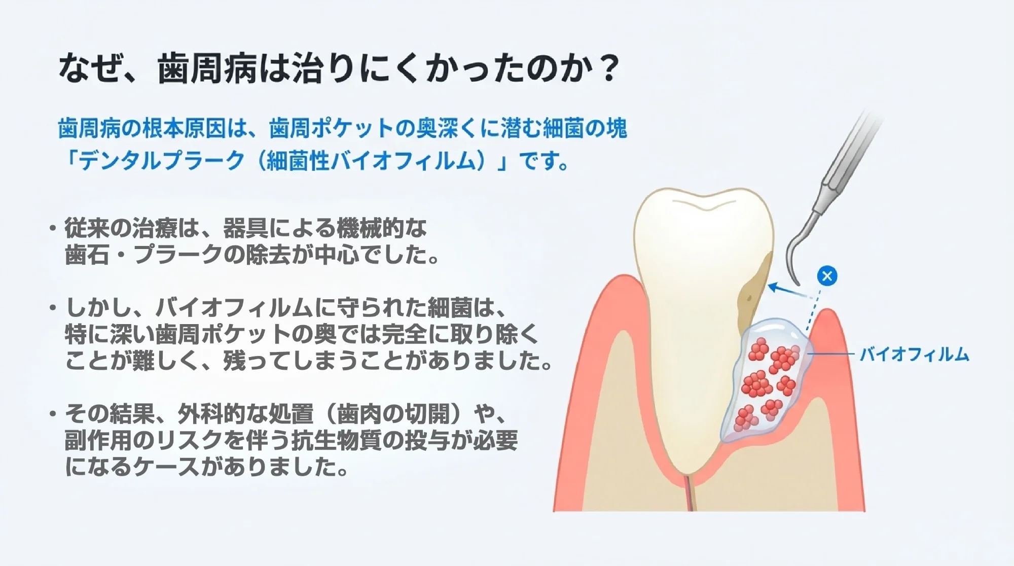 なぜ、歯周病は治りにくかったのか？歯周病の根本原因は、歯周ポケットの奥深くに潜む細菌の塊「デンタルプラーク（細菌性バイオフィルム）」です。従来の治療は、器具による機械的な歯石・プラークの除去が中心でした。しかし、バイオフィルムに守られた細菌は、特に深い歯周ポケットの奥では完全に取り除くことが難しく、残ってしまうことがありました。