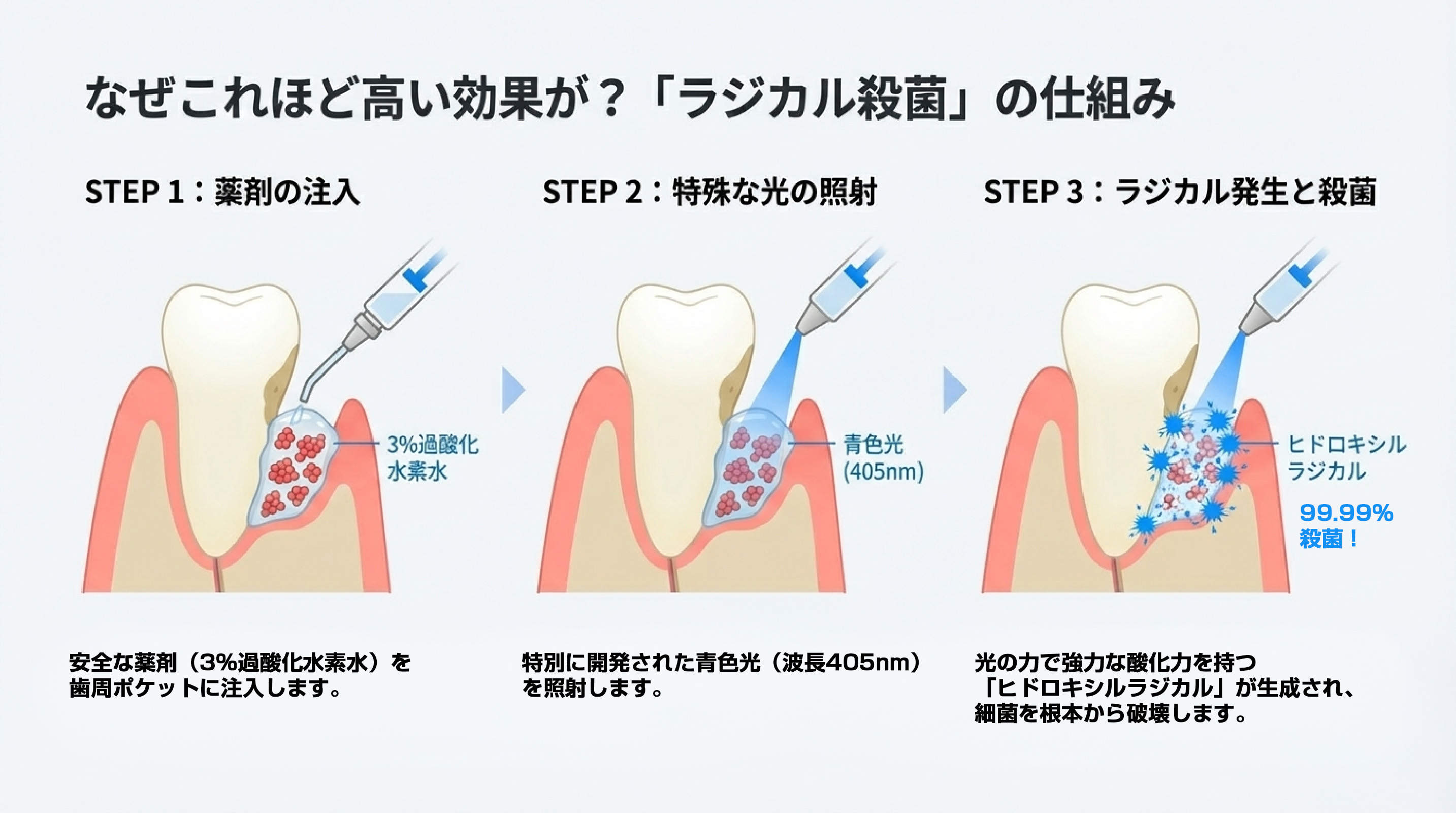 なぜこれほど高い効果が？「ラジカル殺菌」の仕組み STEP1:薬剤の注入 安全な薬剤（3%過酸化水素水）を歯周ポケットに注入します。STEP2:特殊な光の照射 特別に開発された青色光（波長405nm）を照射します。STEP3:ラジカル発生と殺菌 光の力で強力な酸化力を持つ「ヒドロキシルラジカル」が生成され、細菌を根本から破壊します。99.99%殺菌！